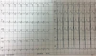 Mixed Hypertrophic and Dilated Phenotype of Cardiomyopathy in a Patient With Homozygous In-Frame Deletion in the MyBPC3 Gene Treated as Myocarditis for a Long Time